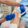 What Is the Success Rate of Radiofrequency Ablation