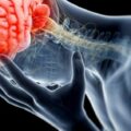 Can Whiplash Cause Brain Injury