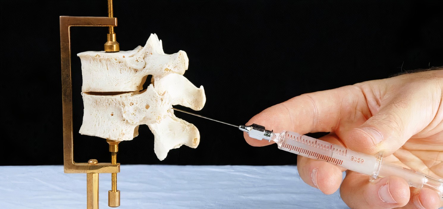 How Do Epidural Steroid Injections Work
