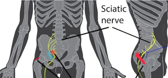 What Causes Sciatic Nerve Pain, FMPM