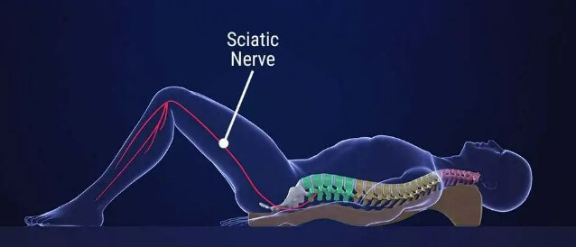Sciatic Nerve Pain