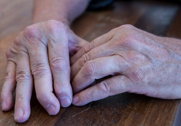 Arthritis