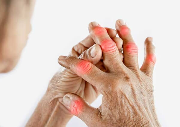 Arthritis