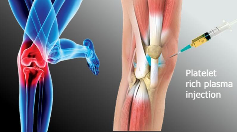 PRP Therapy