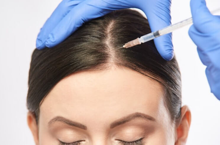 PRP Therapy for Hair Loss