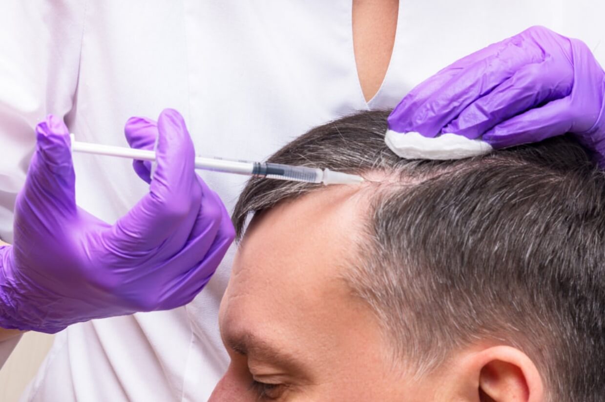 PRP Therapy for Hair Loss
