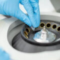 PRP Treatments