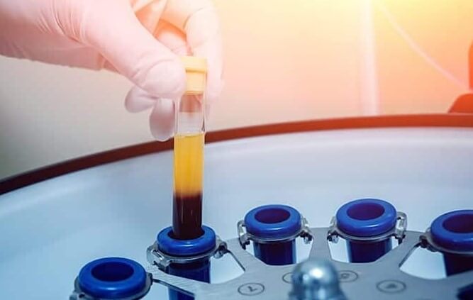PRP Hair Restoration