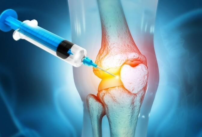 PRP for Knee Pain