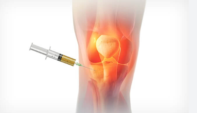 Knee Pain PRP Therapy