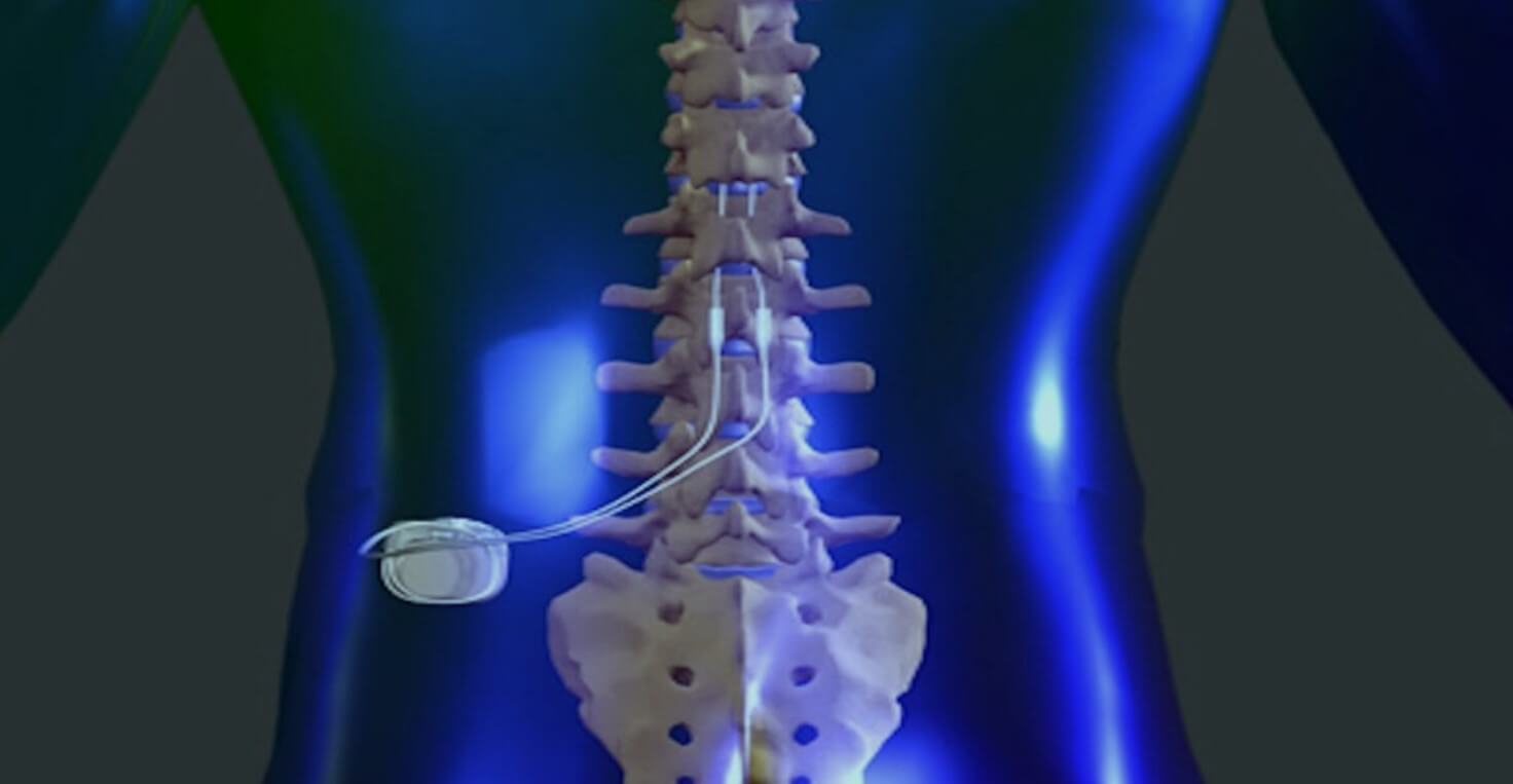 Peripheral Nerve Stimulation