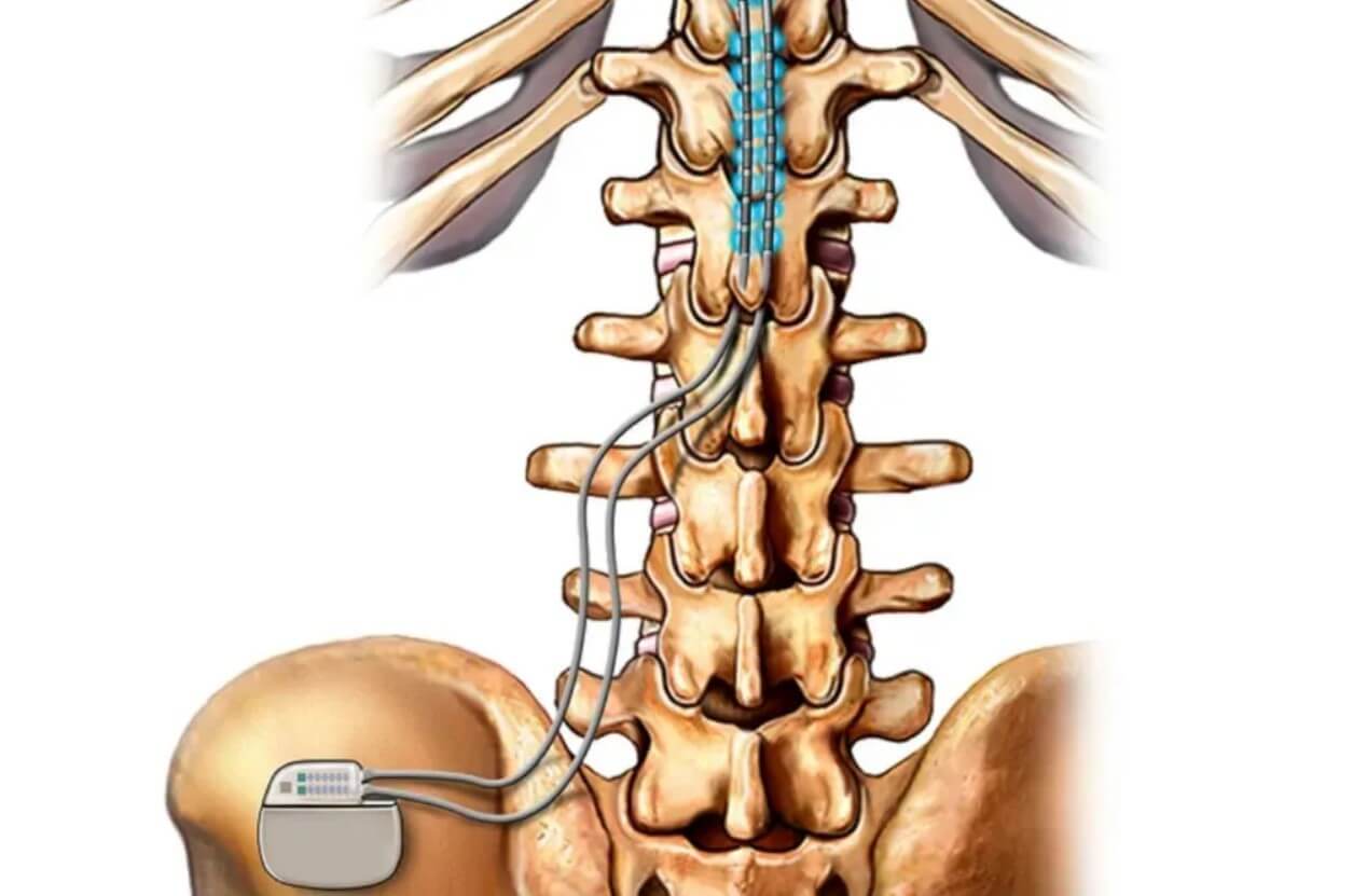Spinal Cord Stimulation Spring Hill FL