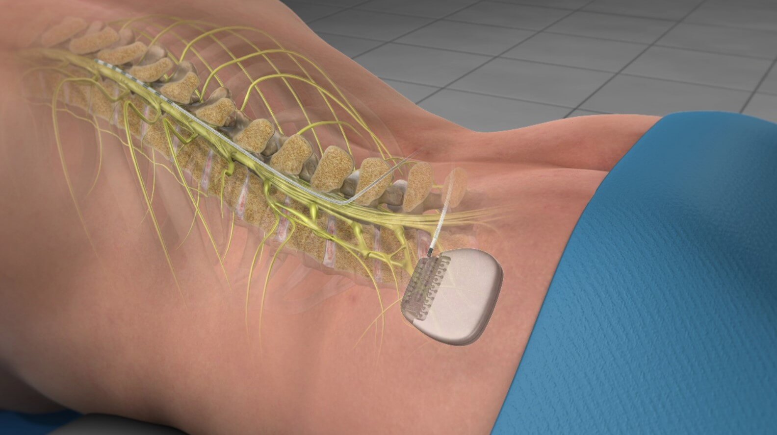 Spinal Cord Stimulation Spring Hill FL