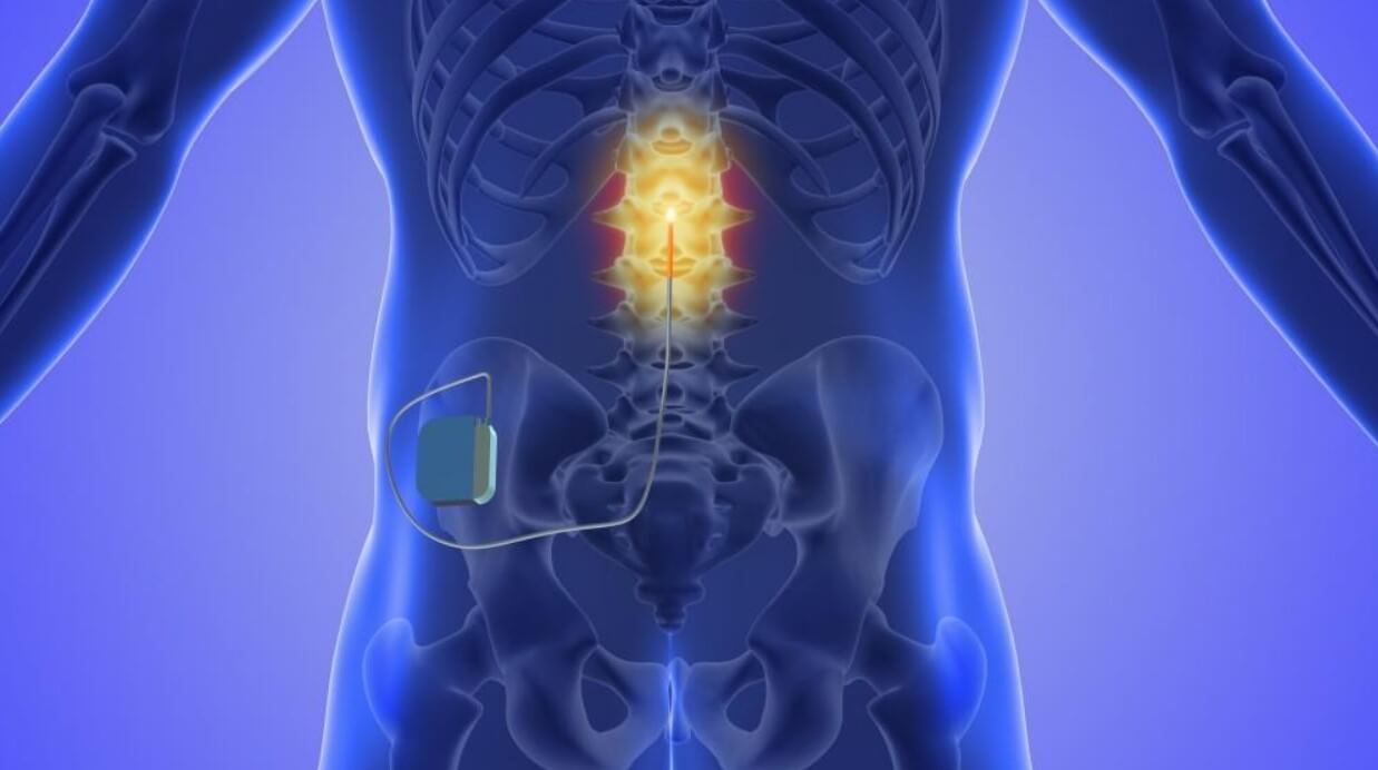 Spinal Cord Stimulation St Petersburg FL