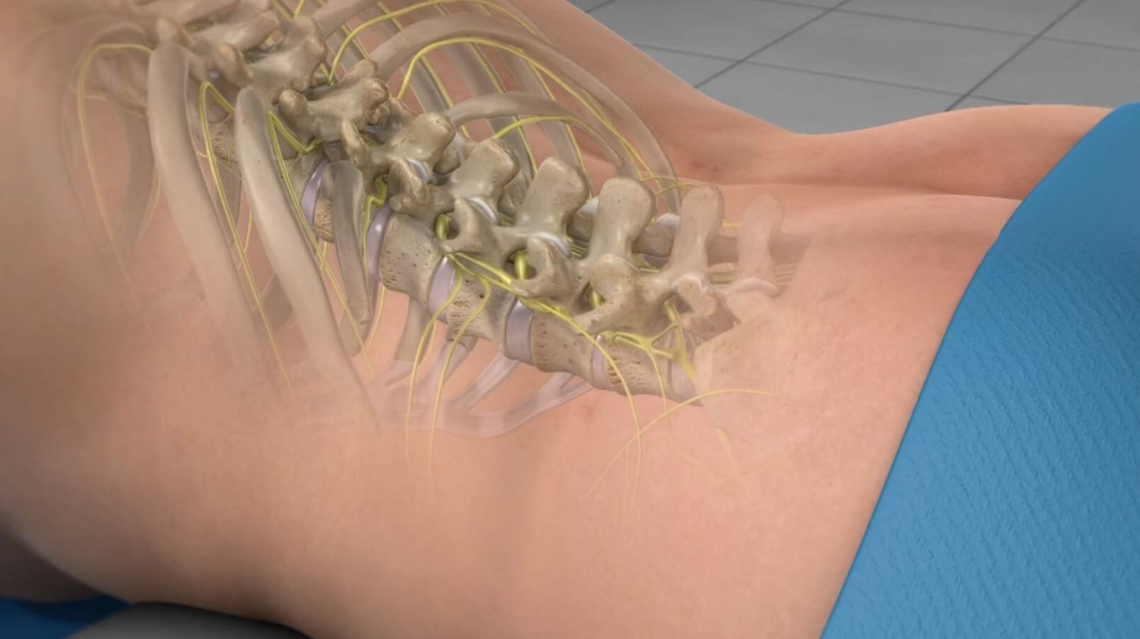 Spinal Cord Stimulators