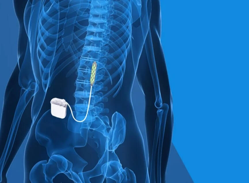 Spinal Cord Stimulators