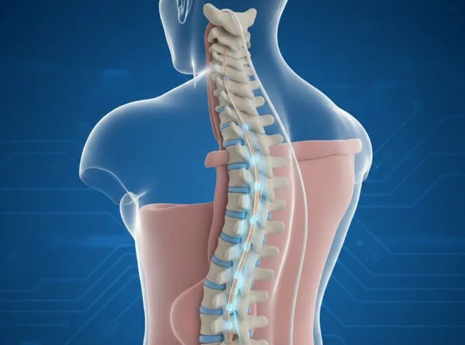 Spinal Cord Stimulation Tampa FL