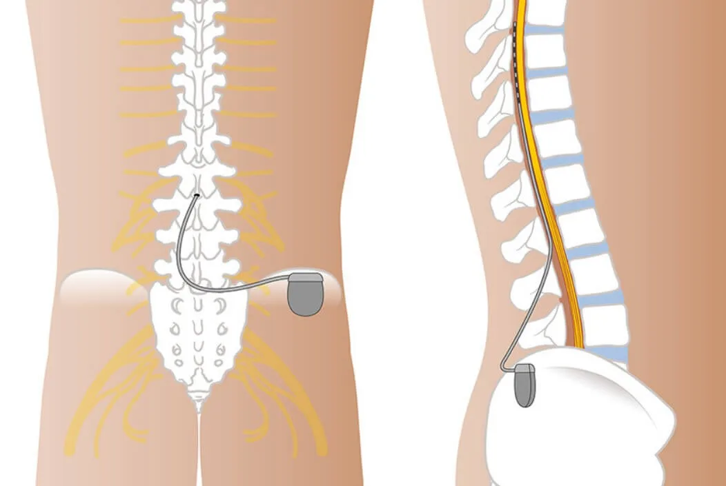 How Does a Spinal Cord Stimulator Work